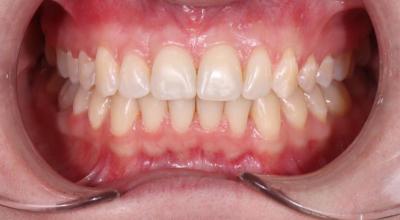 Зубы после брекетов
