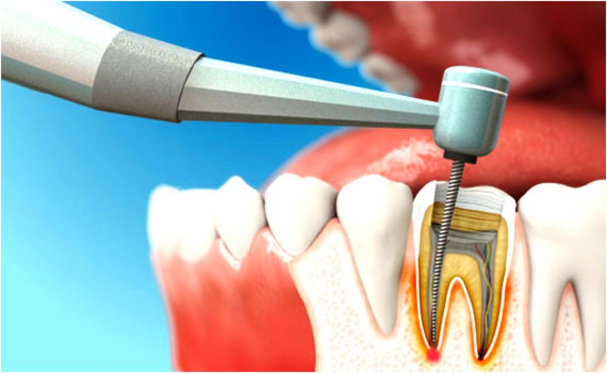 Как определить что нерв в зубе не удален?